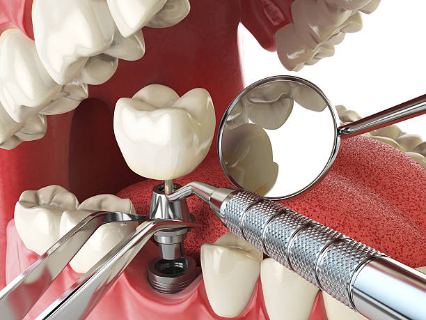 Best Emergency Treatment for Dental Infections or Abscesses in Purdy, MO